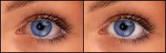 Eye Whitening -- before & after