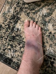 bruised ankle.jpg