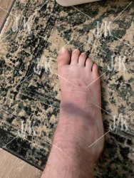 bruised ankle progressing.jpg