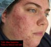 acne_rosacea_fix-Color_Mechanic_0003_annotated_ after selective color.jpg