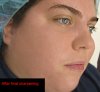 acne_rosacea_fix-Color_Mechanic_0000_annotated_ after final sharpening.jpg
