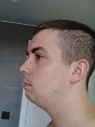 overbite edited.jpg overbite edited.jpg